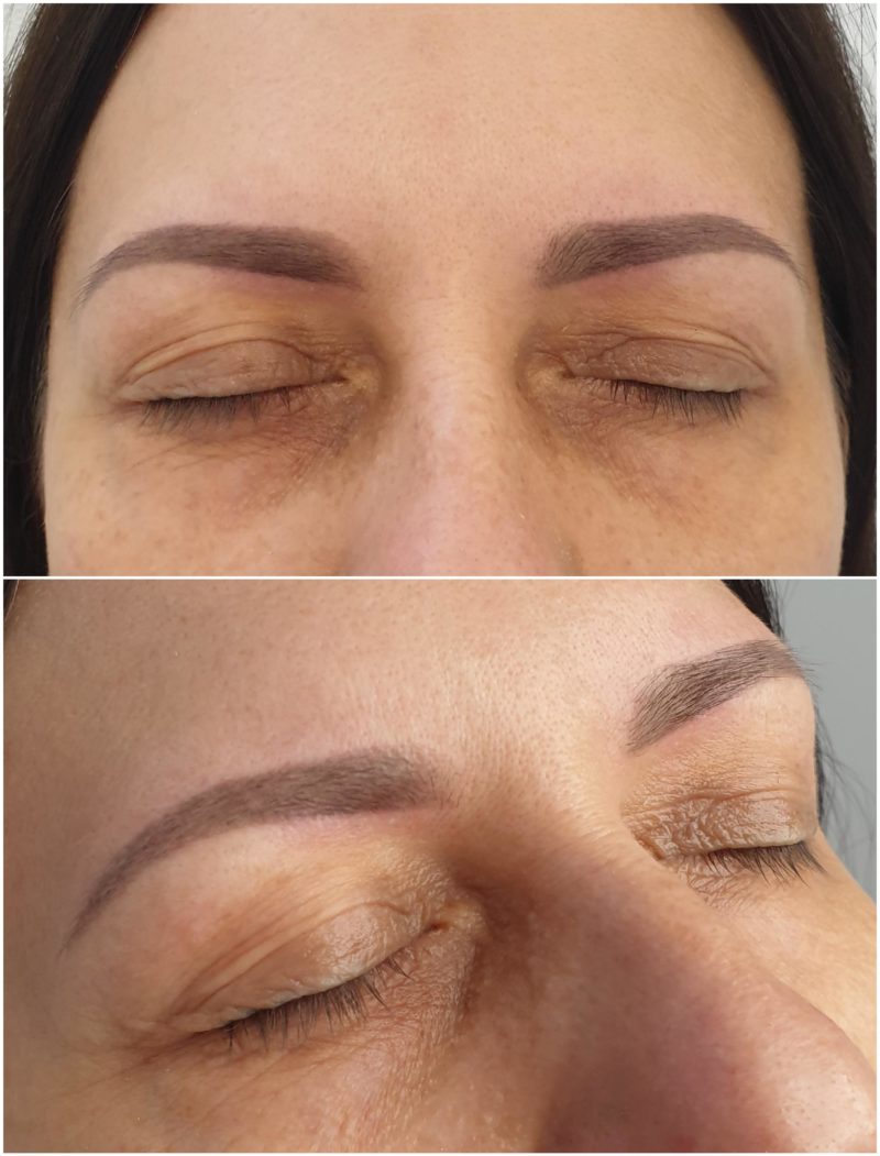 Wygojone brwi (miesiąc po pierwszym zabiegu)