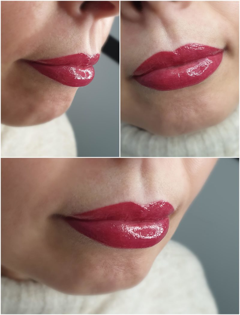 Usta bezpośrednio po zabiegu